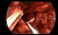 Hiatal Mesh Reinforcement for Large Hiatal Hernia and Toupet Fundoplication