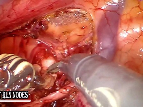 Robotic McKeowns Esophago-Gastrectomy