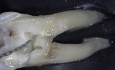Caries Leveraged Access and Single Stroke TCA Technique