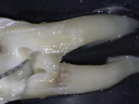 Caries Leveraged Access and Single Stroke TCA Technique