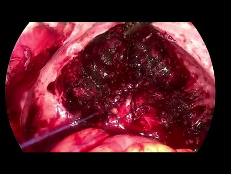 SELS - Deep Infiltrating Endomrtiosis