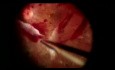 Viscodissection for Tractional Fibrotic Proliferative Diabetic Retinopathy