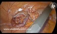 Incidentally Burning of Cecum During Appendectomy. How do I treat it?