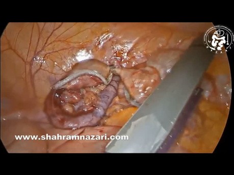 Incidentally Burning of Cecum During Appendectomy. How do I treat it?