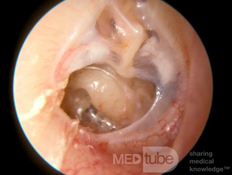 Severe Atelectasis Resembling a Perforation of the Tympanic Membrane