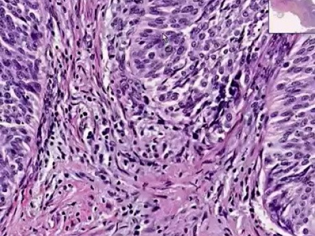 Urothelial carcinoma Grade I - Histopathology - Bladder