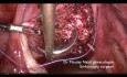 Myomectomy With Internal Iliac Arteries Control