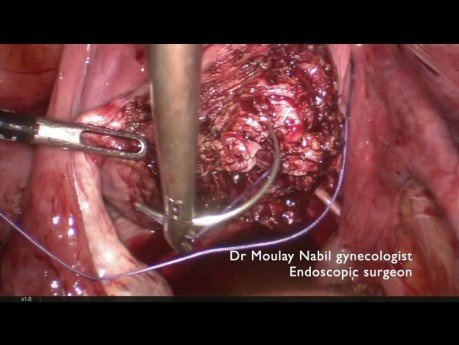 Myomectomy With Internal Iliac Arteries Control