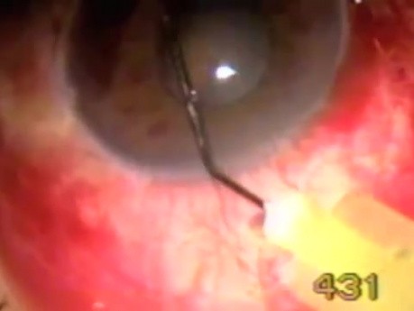 Neovascular Glaucoma - Singh Filtration