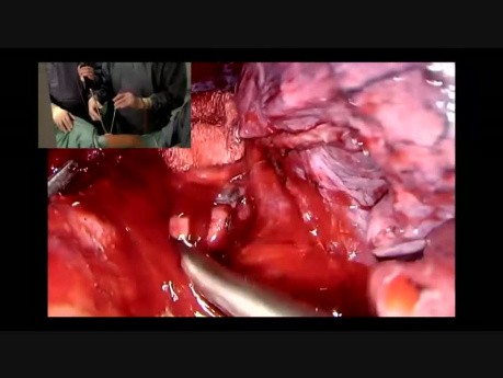 Non Intubated Uniportal VATS Complex Lobectomy using the Harmonic Shears (live surgery)