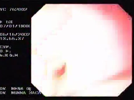 Enormous Tubulovillous tumor (2 of 2)