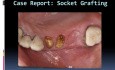 When Reconstruction Of An Entire Tooth Socket May Be Necessary?