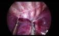 Uniportal VATS Right Lower Lobectomy in a 1 Year Old Child due to a CCAM