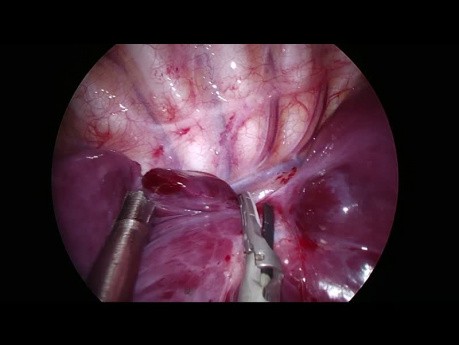 Uniportal VATS Right Lower Lobectomy in a 1 Year Old Child due to a CCAM
