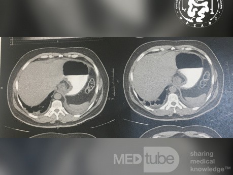 A Nissen Fundoplication CT Scans