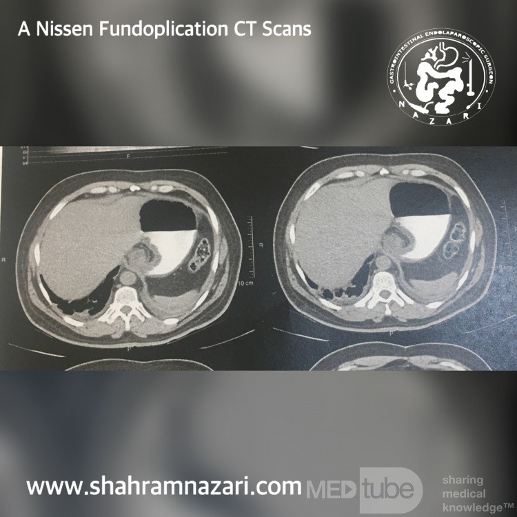 A Nissen Fundoplication CT Scans