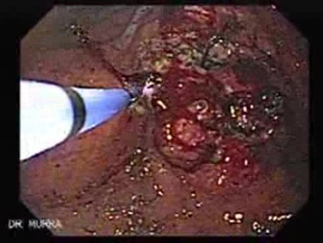 Adenocarcinoma of the Antrum (5 of 5)