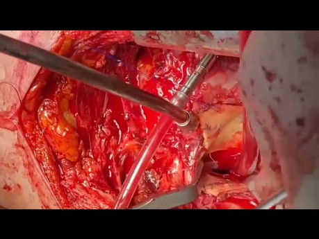 Patient With Redo Operation of Sinus Valsalva and Previous Twice AVR 