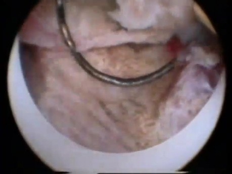 Hysteroscopic Removal of Endometrium