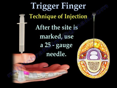 Trigger Finger  - Video Lecture