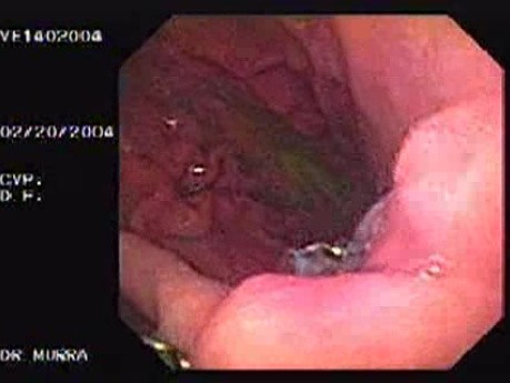 Intraluminal Endoscopic Suturing - A Follow Up After 6 Months