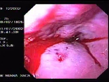 Hemorrhage Due Status Post Rubber Band Ligation of Esophageal Varices - Bleeding and the Presence of Blood Clot