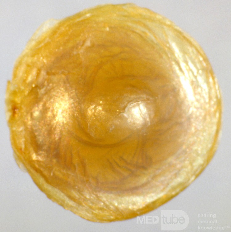 Extruded Cast of the Tympanic Membrane Following Severe Acute Otitis Media, Medial View