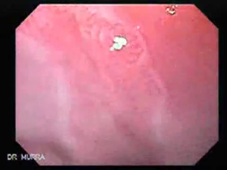 Endoscopic view of Barrett Esophagus (1 of 9)