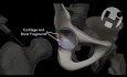 Open Reduction and Internal Fixation of the Hip