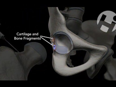 Open Reduction and Internal Fixation of the Hip