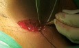 Implant Placement Using the Cephalic Vein Denudation Technique 