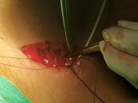 Implant Placement Using the Cephalic Vein Denudation Technique 