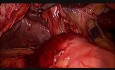 Difficult Laparoscopic Cholecystectomy for Large Gallbladder Stone for Chronic Cholecystitis