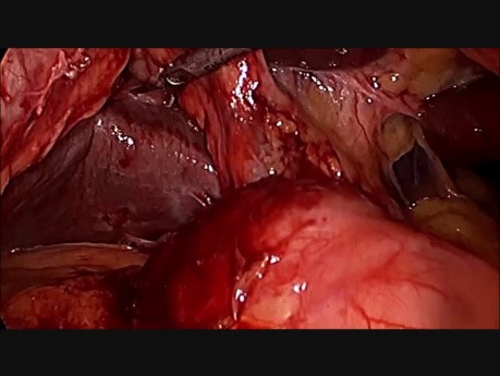 Difficult Laparoscopic Cholecystectomy for Large Gallbladder Stone for Chronic Cholecystitis
