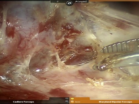 Carcinoid Tumor at Intermedius Bronchus