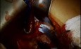 Large Left Myxoma Resected by Minimally Invasive Techniques. Narration by the operating surgeon.
