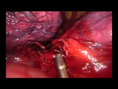 Subcostal Uniportal VATS Left Lower Lobectomy