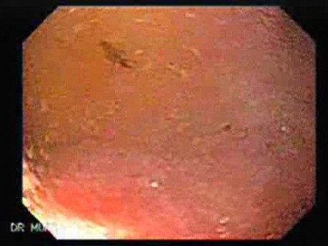 Duodenal Diverticula (1 of 2)