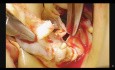 Minimally Invasive Bentall Procedure