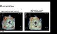 Introduction to 3D Echocardiography Part 1: Image Acquisition and Processing