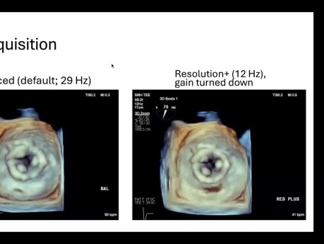 Introduction to 3D Echocardiography Part 1: Image Acquisition and Processing