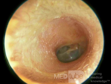 External Auditory Canal Junction [the Isthmus]