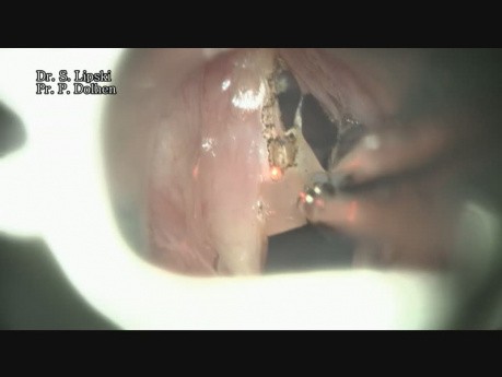 Reinke's Edema of the Left Vocal Fold Treated with Laser