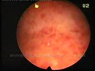 Chronique Endometritis