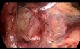 Laparoscopic Total Proctocolectomy with End Ileostomy