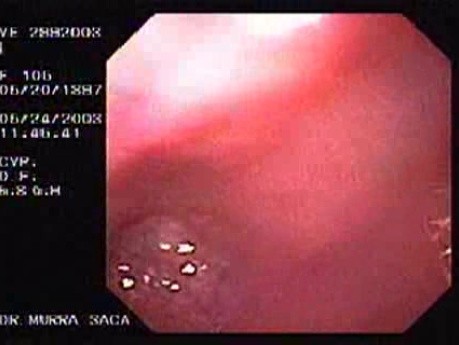 Barret´s Esophagus long segment -106-year-old female patient (4 of 4)