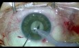 White Hypermature Cataract + 3.5mm Pupil + PEX