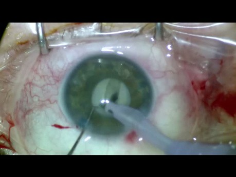 White Hypermature Cataract + 3.5mm Pupil + PEX