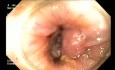 Laterally Spreading Adenoma