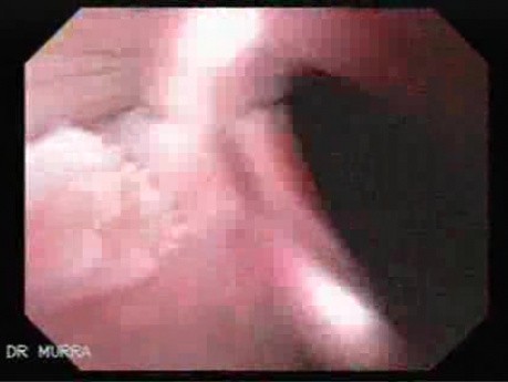 Esophageal Papilloma of the Lower Third  - Part 2